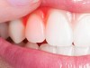 التهاب لثه چیست؟ راه های پیشگیری و درمان