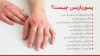 پسوریازیس (صدف) چیست؟ علائم، علل، تصاویر و درمان
